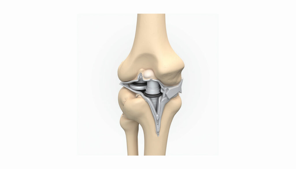 Bone Fixation Devices healthcare platform