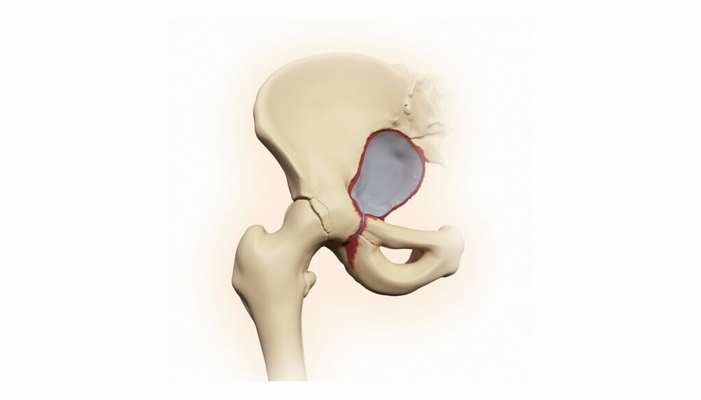 Labral Reconstruction Grafts healthcare platform